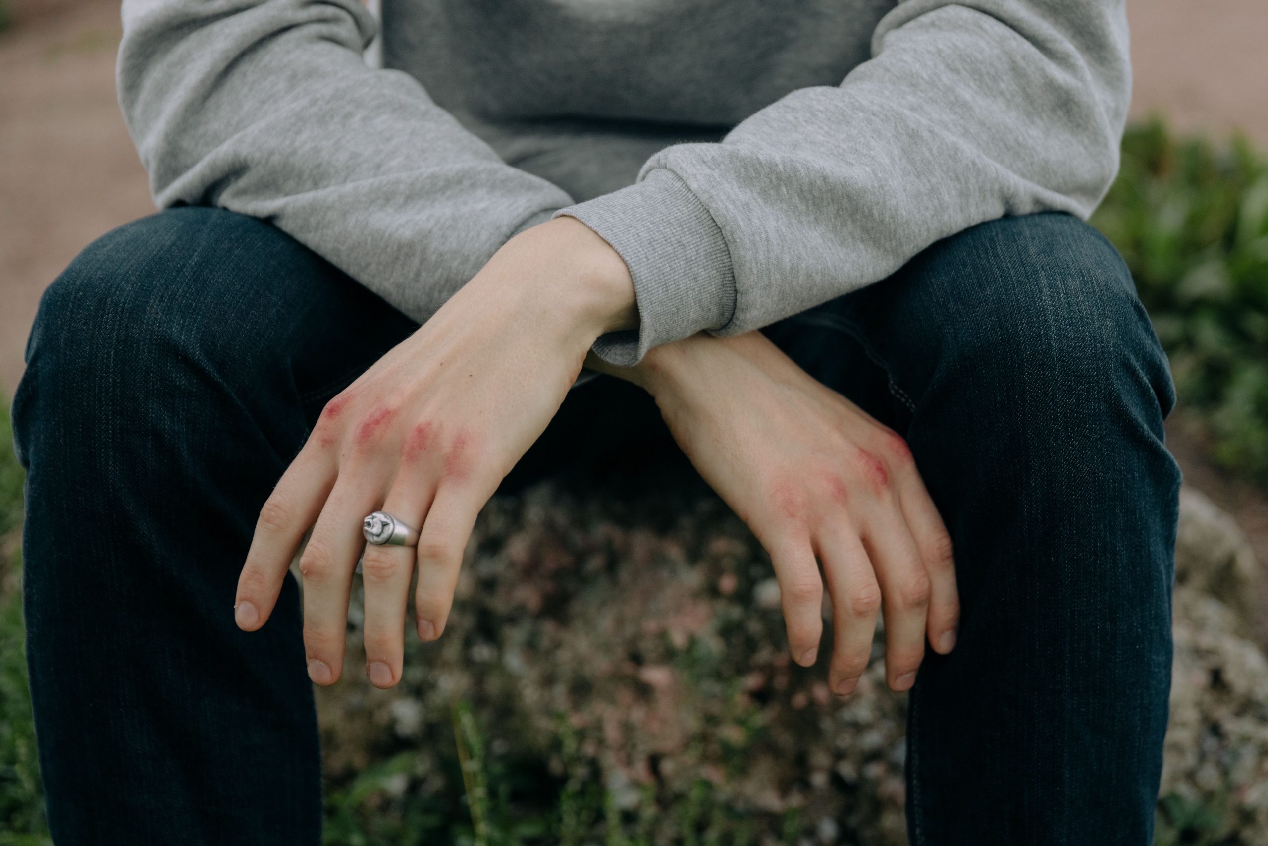 Mains contusionnées avec bague sur les genoux