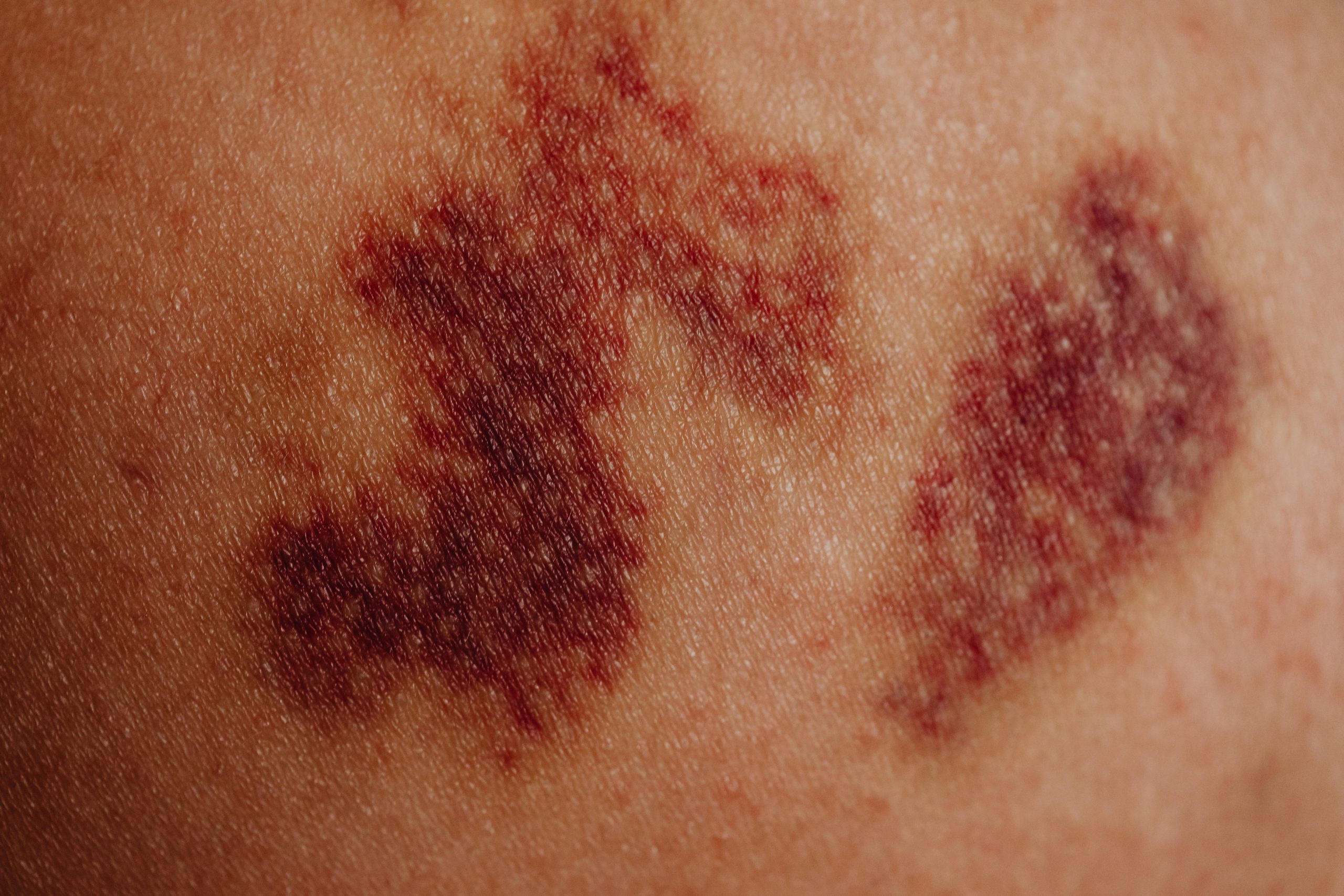 Ecchymose sur la peau avec teinte violacée