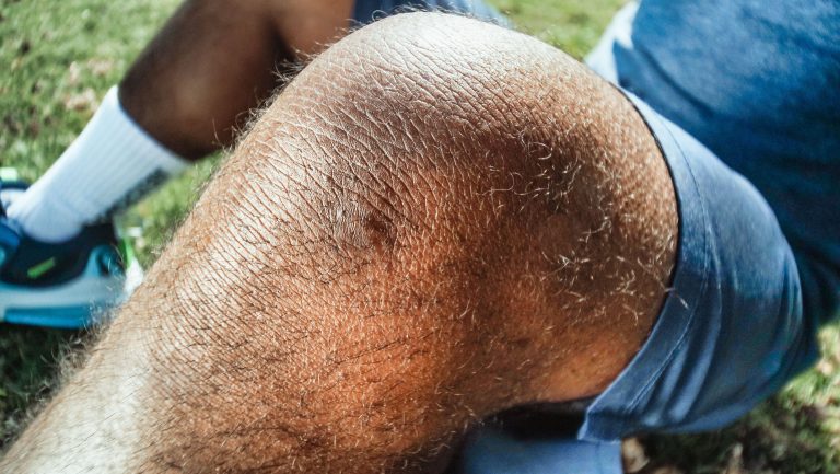 Gros plan d'un genou blessé avec bleu
